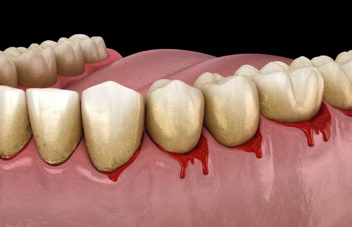 Gum Disease Symptoms: Things to Look Out For in Mansarovar Sector 1, jaipur
