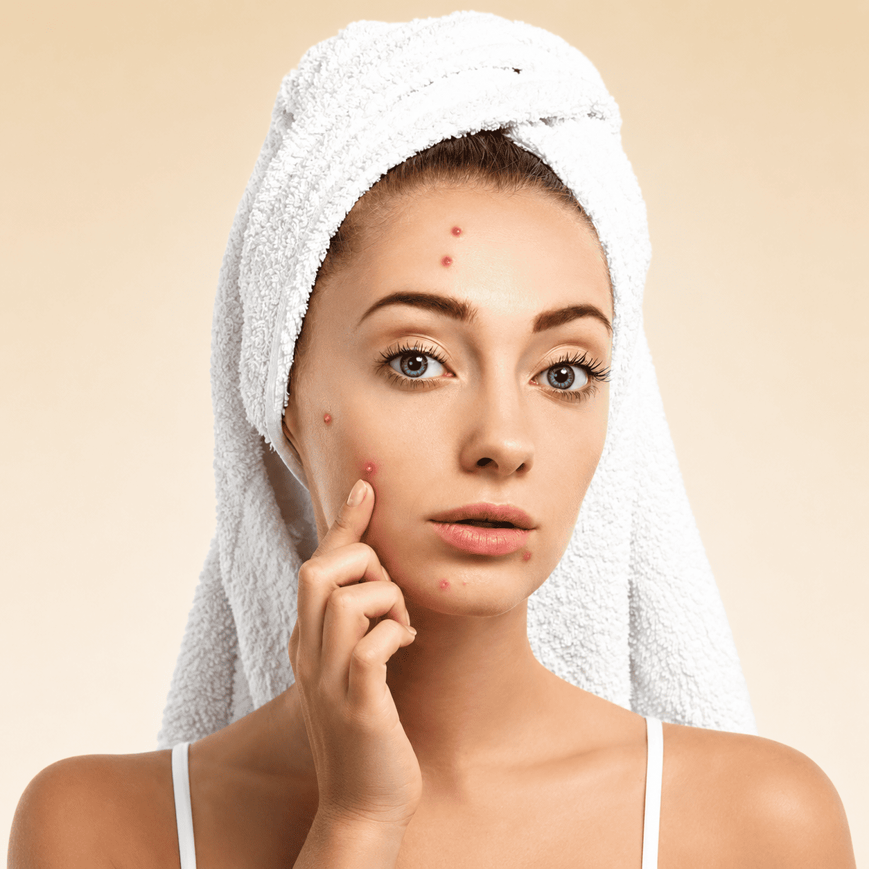 Acne Control