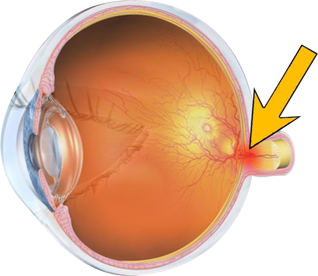 Glaucoma Category
