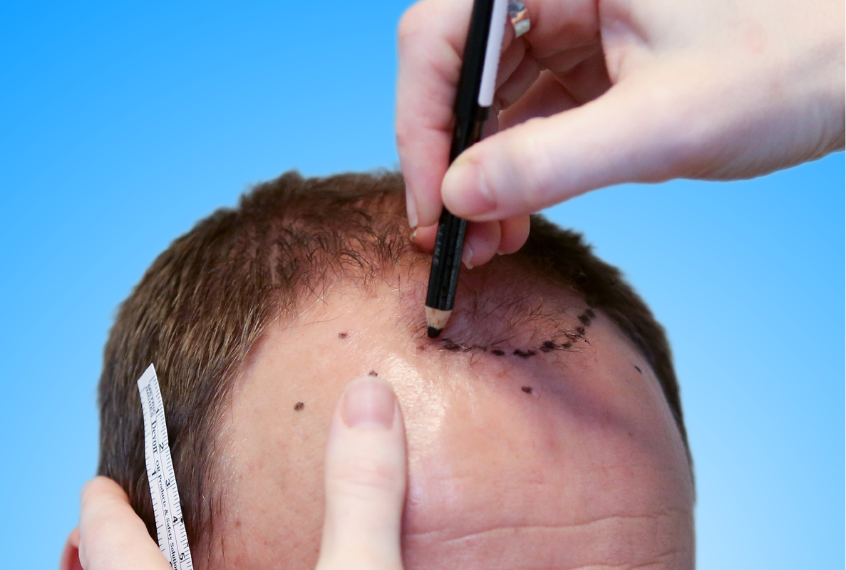 AFT 2.0 Hair Transplant