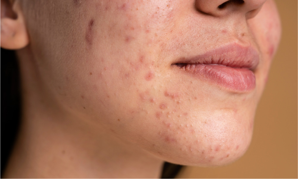 Clear Skin Starts Here: The Complete Guide to Acne Treatment