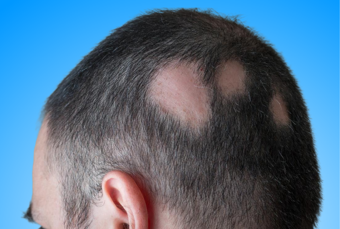 Alopecia / Patchy hairloss
