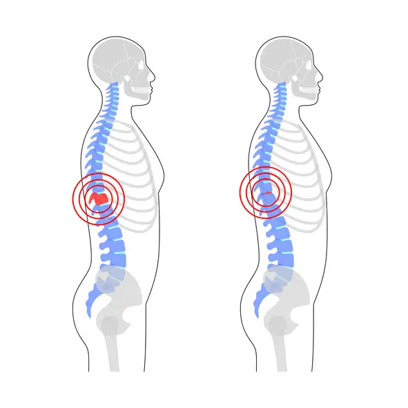 Ankylosing Spondylitis Category