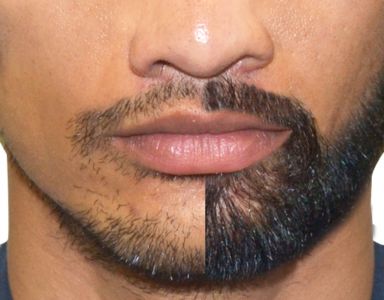 Beard Restoration Category
