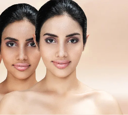 Chemical Peel Treatment