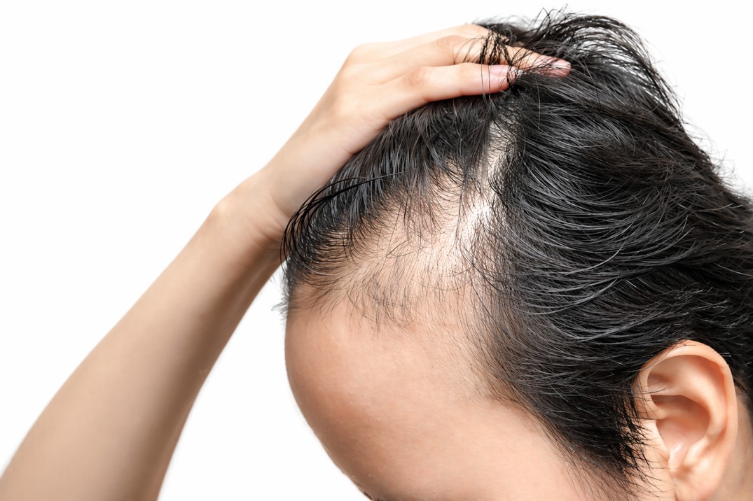 Alopecia In Male