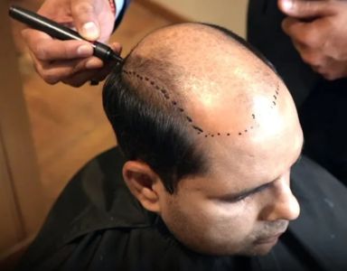 Cosmetic Hair Patch Category