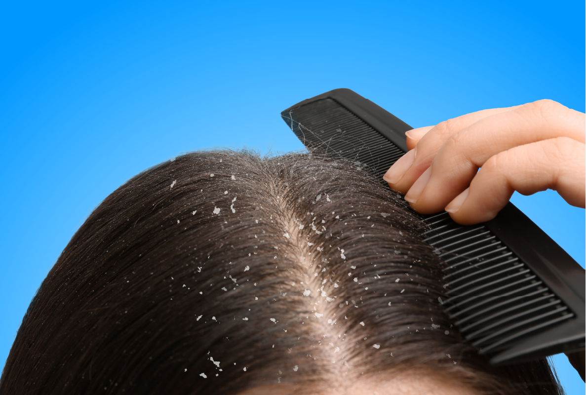 Dandruff Solutions
