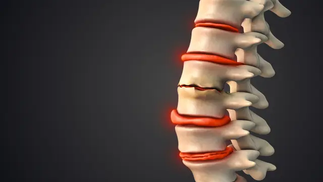 Degenerative Disc Disease Category