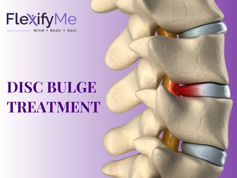 Bulging Disc: what Is It, Symptoms, Causes, Treatment Options Bulging Disc: what Is It, Symptoms, Causes, Treatment Options