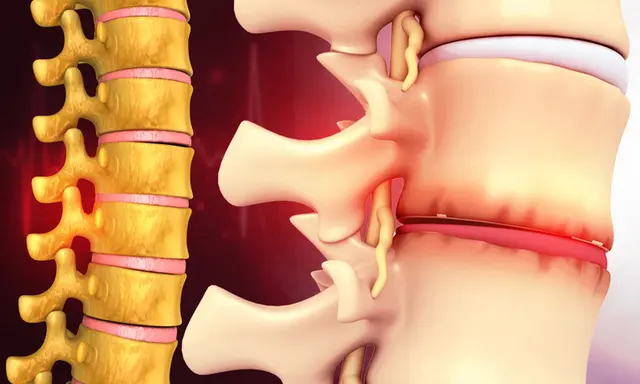 Disc Bulge Treatment