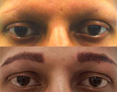 Eyebrow Restoration Category