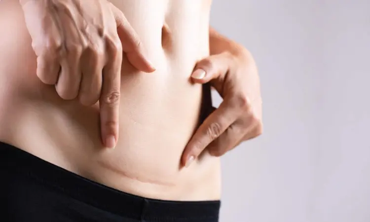 How To Keep C-section Incision Dry When Overweight?