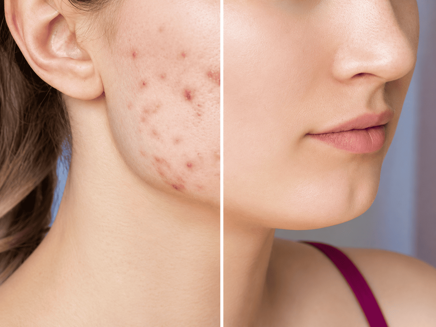 Acne Scar Removal
