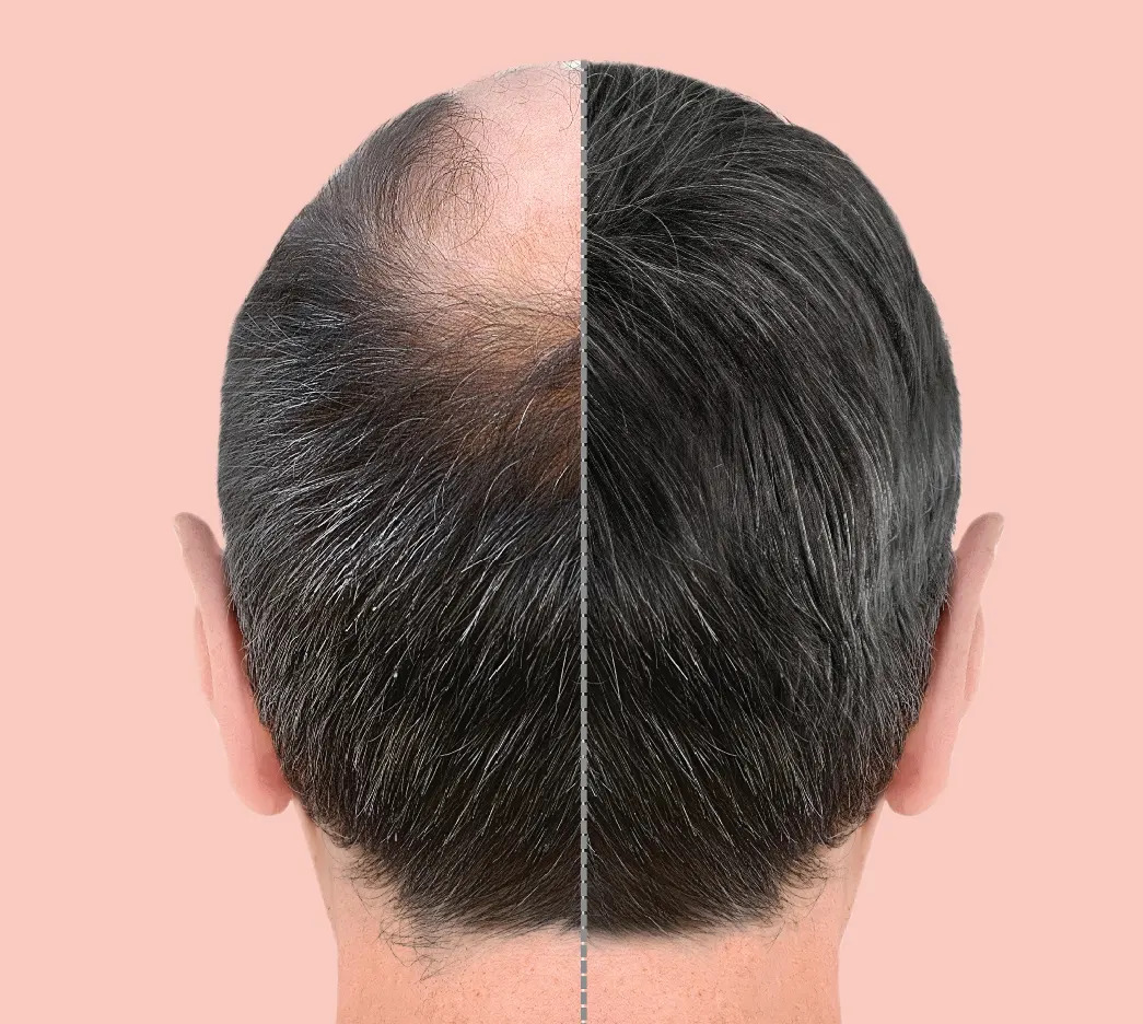 PRP GF Treatment
