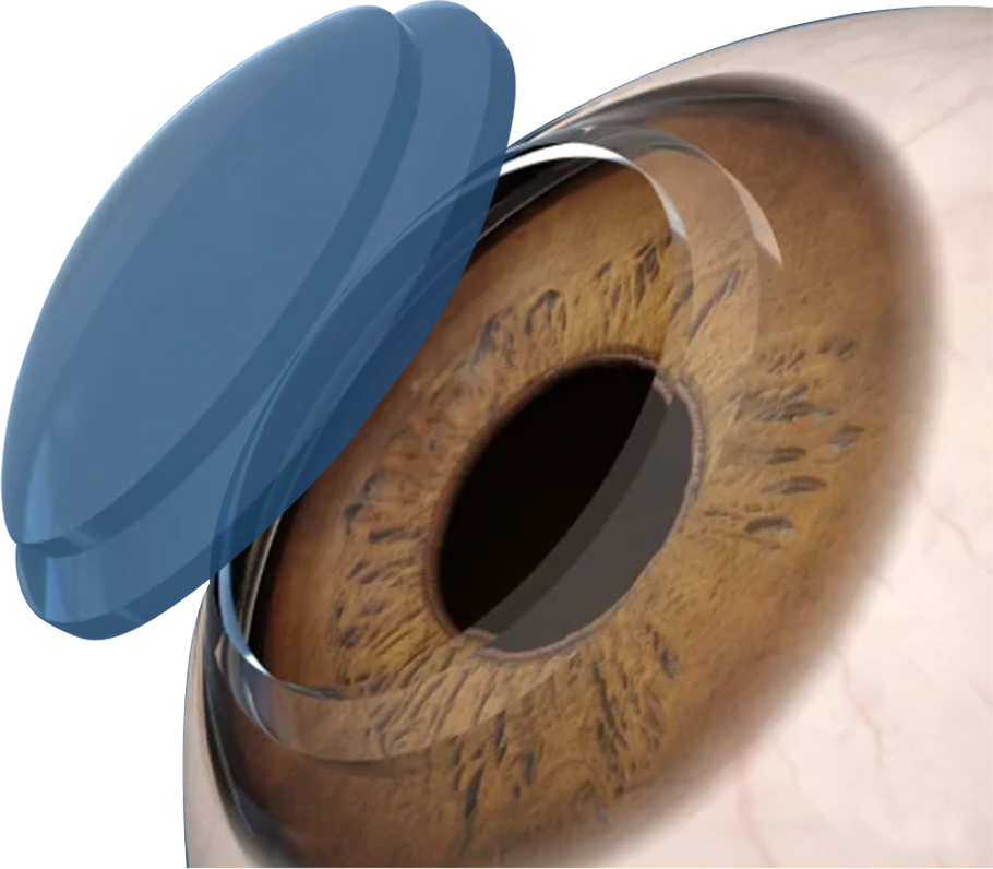 Cornea Category