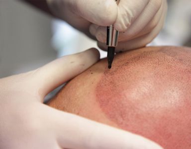 Scalp Micropigmentation Category