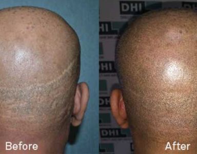 Scar Repair Category