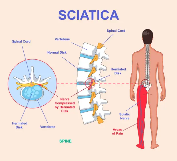 Sciatica Category