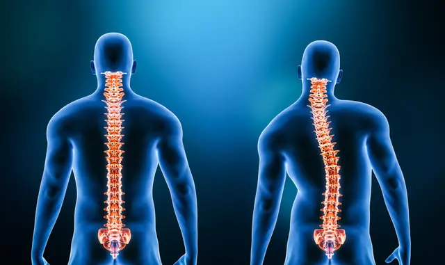 Scoliosis Treatment