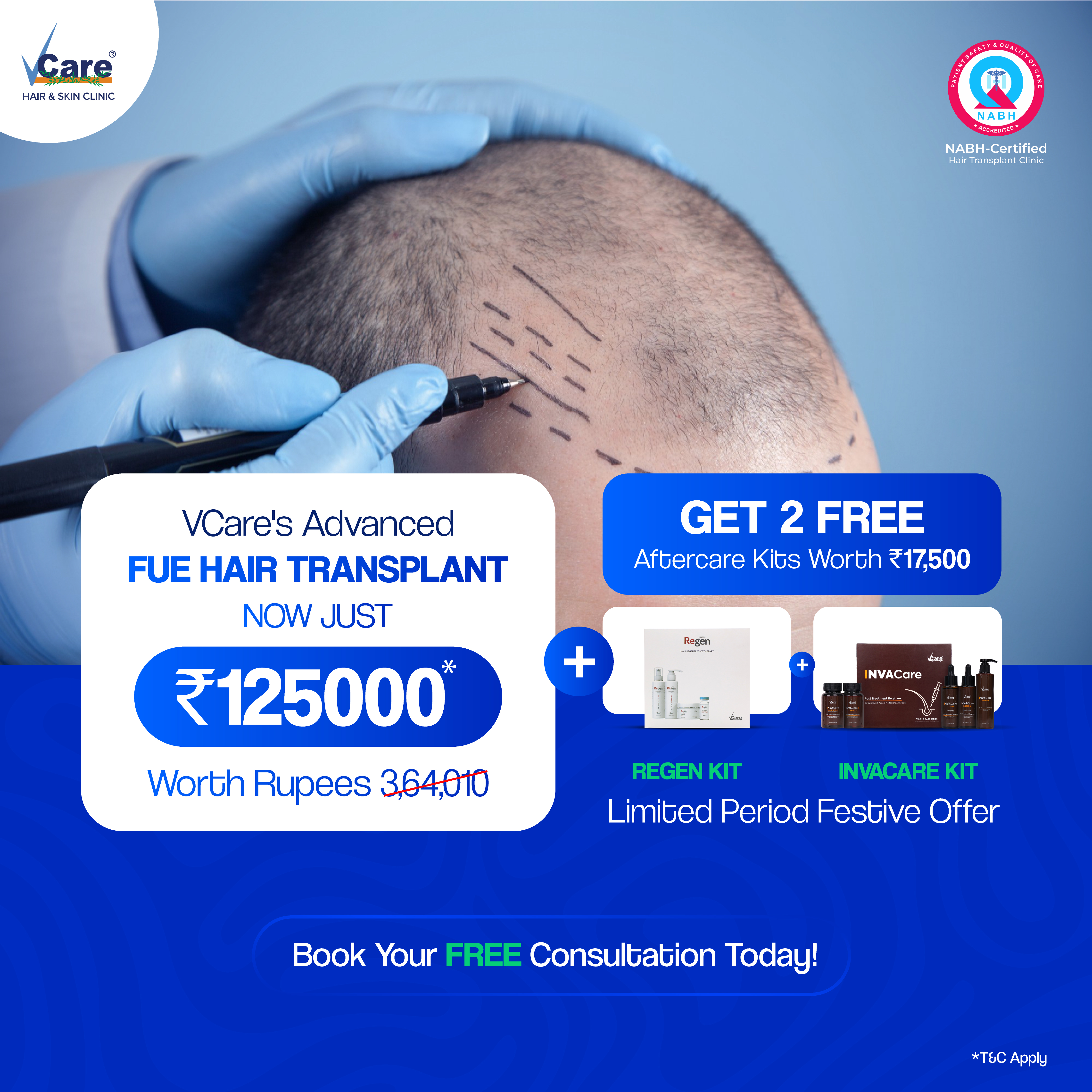 Advanced FUE Hair Transplant at ₹1,25,000 + 2 Free Kits