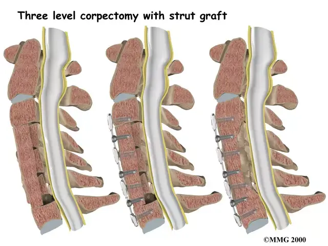 Spinal Canal Stenosis Category