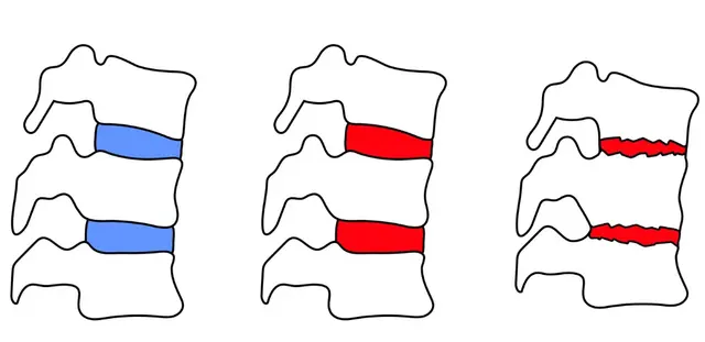 Spondylitis Category