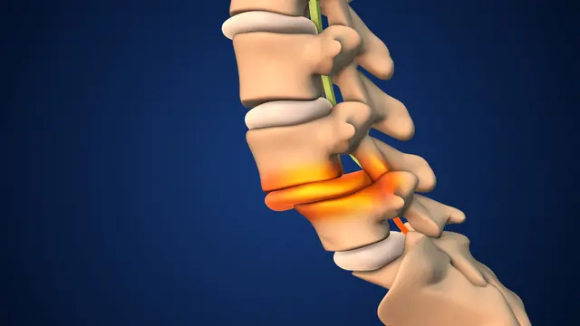 Spondylolisthesis Category