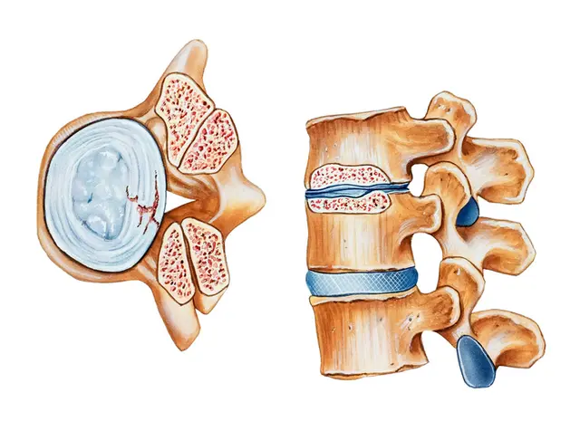 Stenosis Treatment