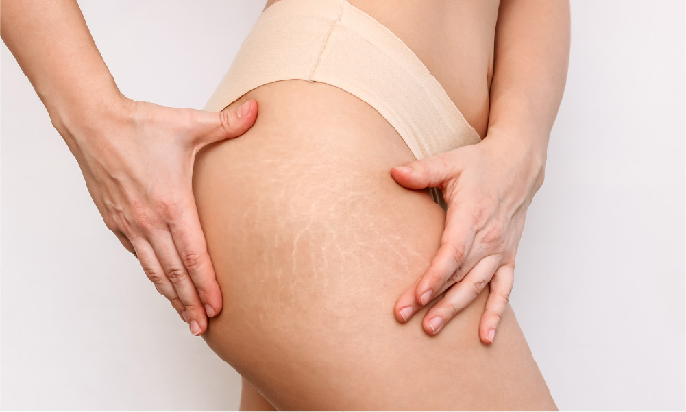 Stretch Mark Removal: Real Treatments That Reduce and Restore Stretch Mark Removal: Real Treatments That Reduce and Restore