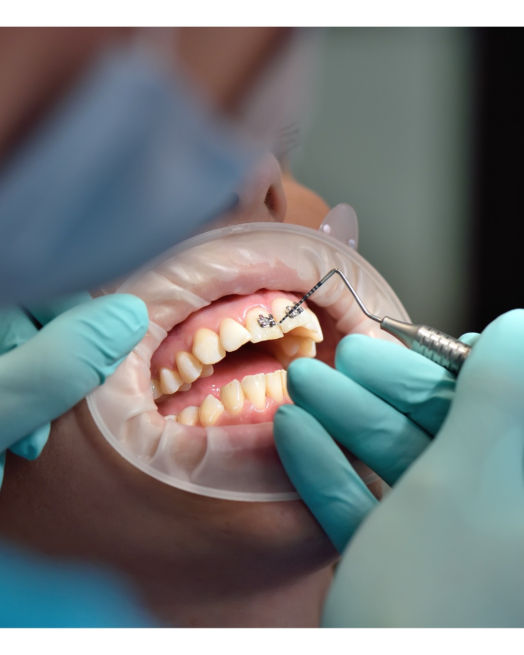 Braces in Mallasandra, bengaluru: Types and Treatment