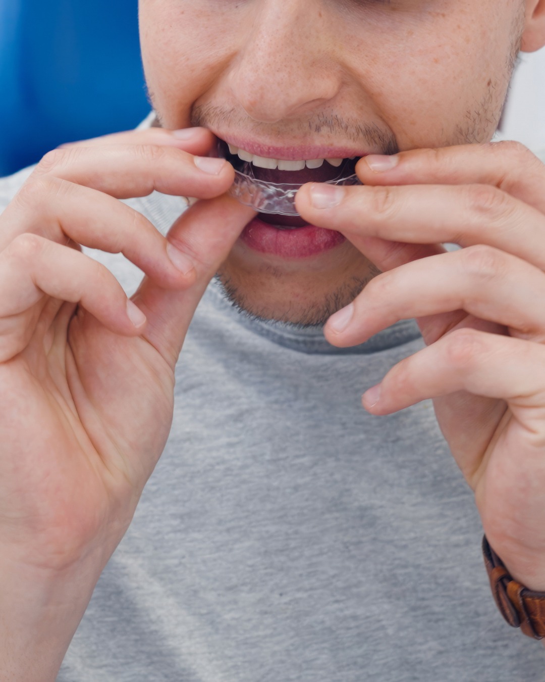 Clear Aligners in Pallavaram, chennai: A Real Guide