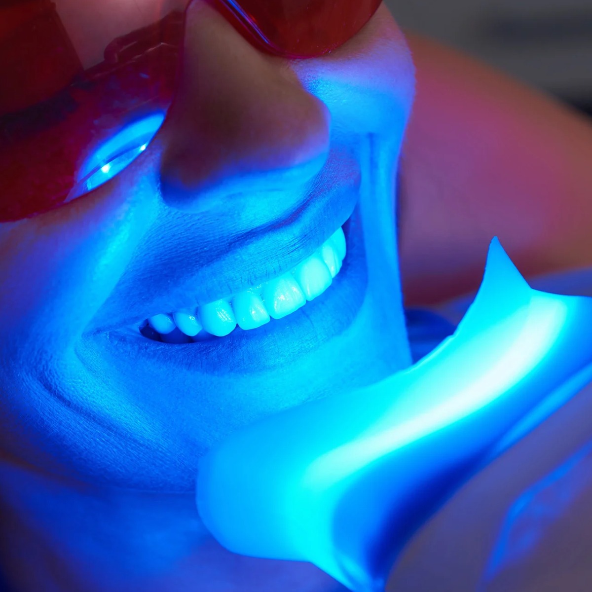 Teeth Whitening in Mallasandra, bengaluru: What Works