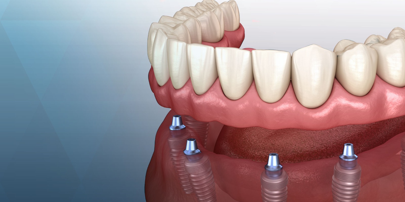 Missing Teeth in Mallasandra, bengaluru: Your Options