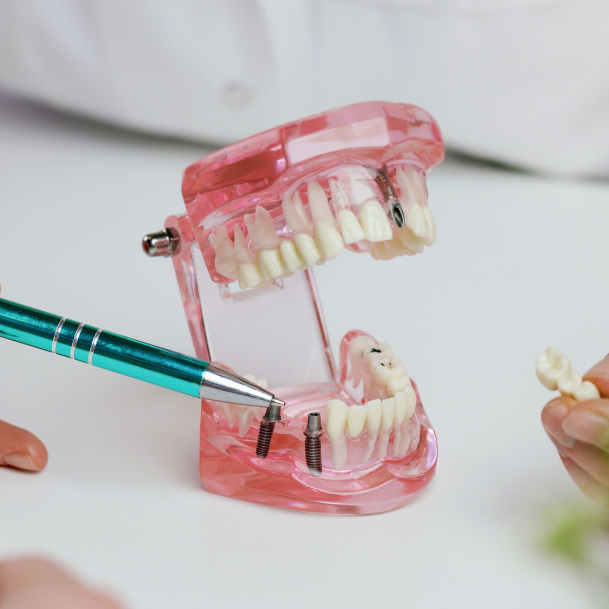 Dental Implants in Mallasandra, bengaluru: Full Process