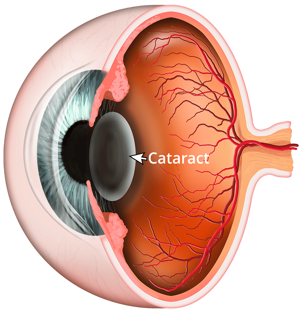 Cataract Category