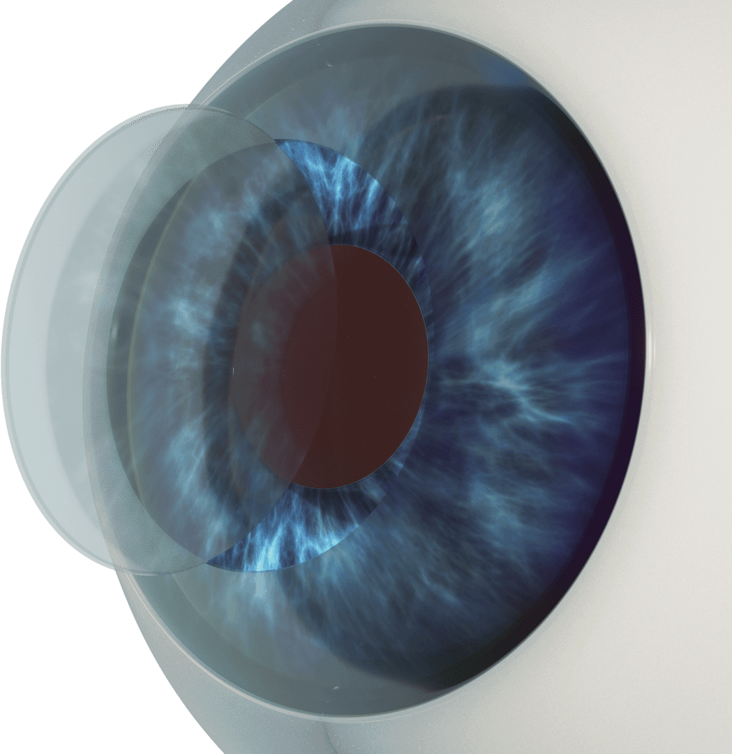 Refractive Surgeries Category