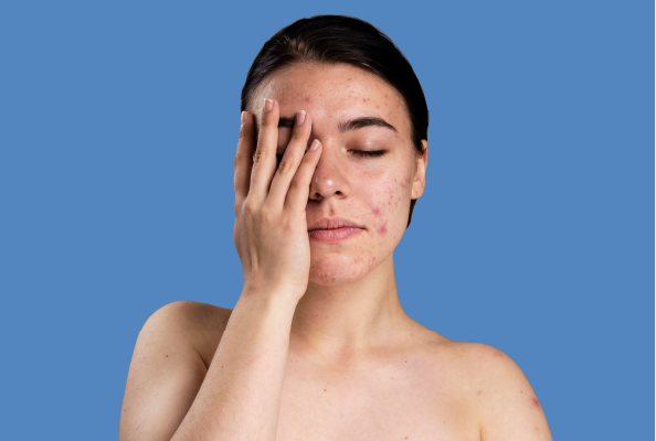 Acne/ Acne Scar Treatment