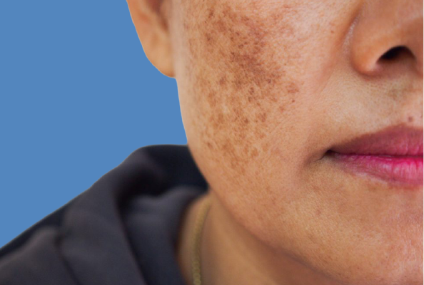 Pigmentation Correction