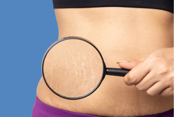 Stretch Mark Repair