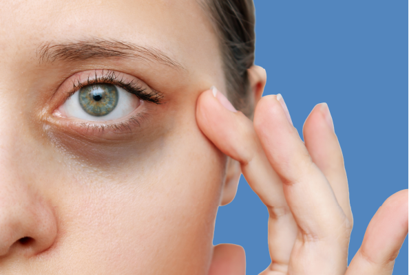 Under- Eye Dark Circles