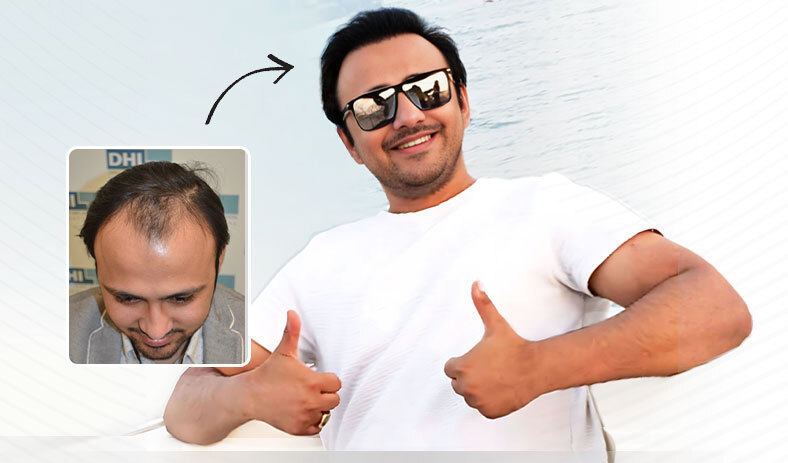 DHI™ India - Best Hair Transplant