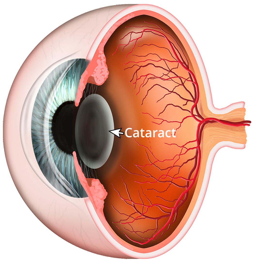 Cataract Surgery in Ghatkopar West, mumbai – Restore Clear Vision with ASG Eye Hospital Cataract Surgery in Ghatkopar West, mumbai – Restore Clear Vision with ASG Eye Hospital