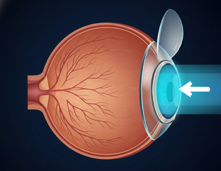 Book Your Cataract Consultation at ASG Eye Hospital in Powai, mumbai Book Your Cataract Consultation at ASG Eye Hospital in Powai, mumbai
