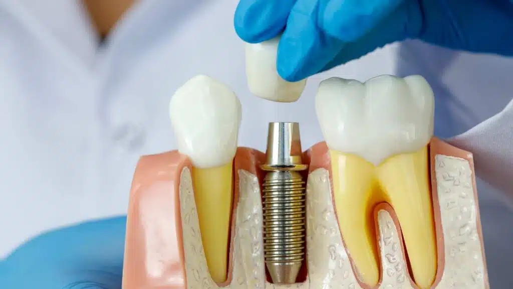 Affordable Dental Implant Cost: Find the Best Options in Pimpri Colony,pimpri-chinchwad Affordable Dental Implant Cost: Find the Best Options in Pimpri Colony,pimpri-chinchwad