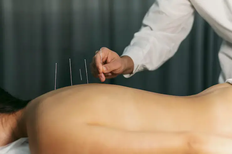 Dry Needling Therapy