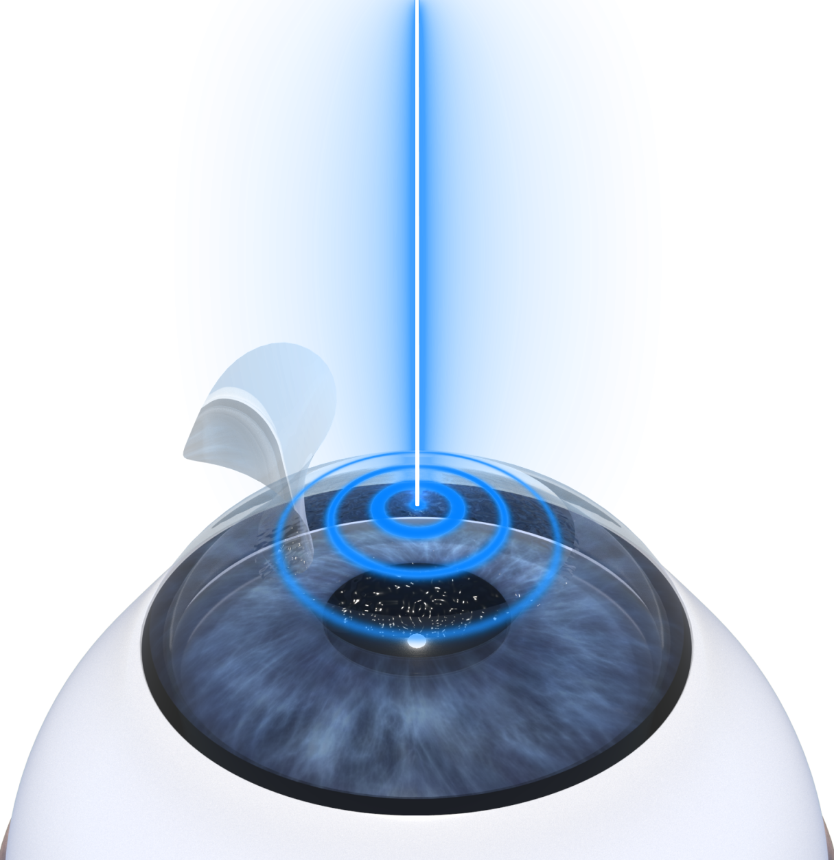 LASIK Surgery Category
