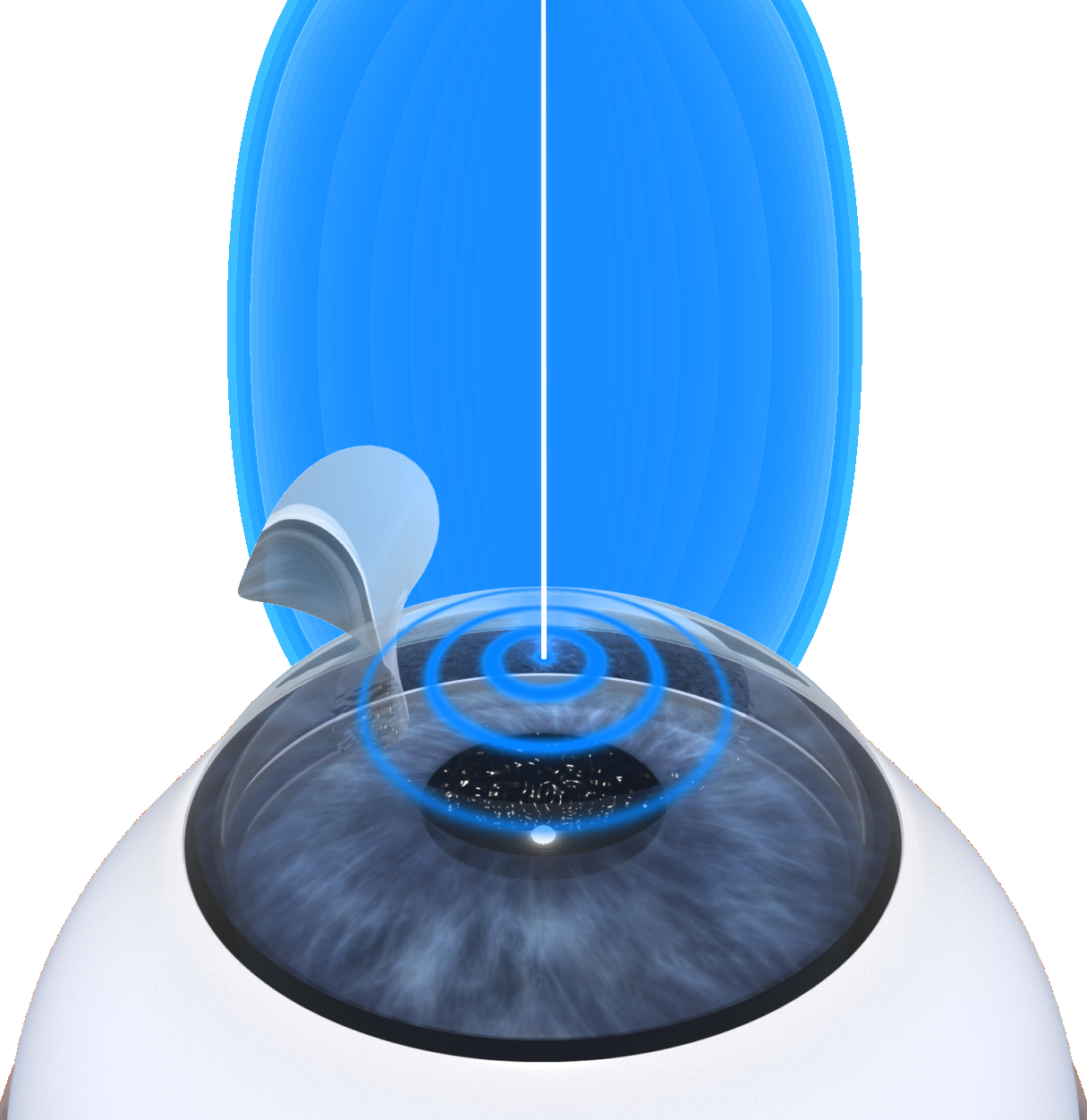LASIK in Vaishali Nagar, bilaspur – Achieve Clear Vision with ASG Eye Hospital