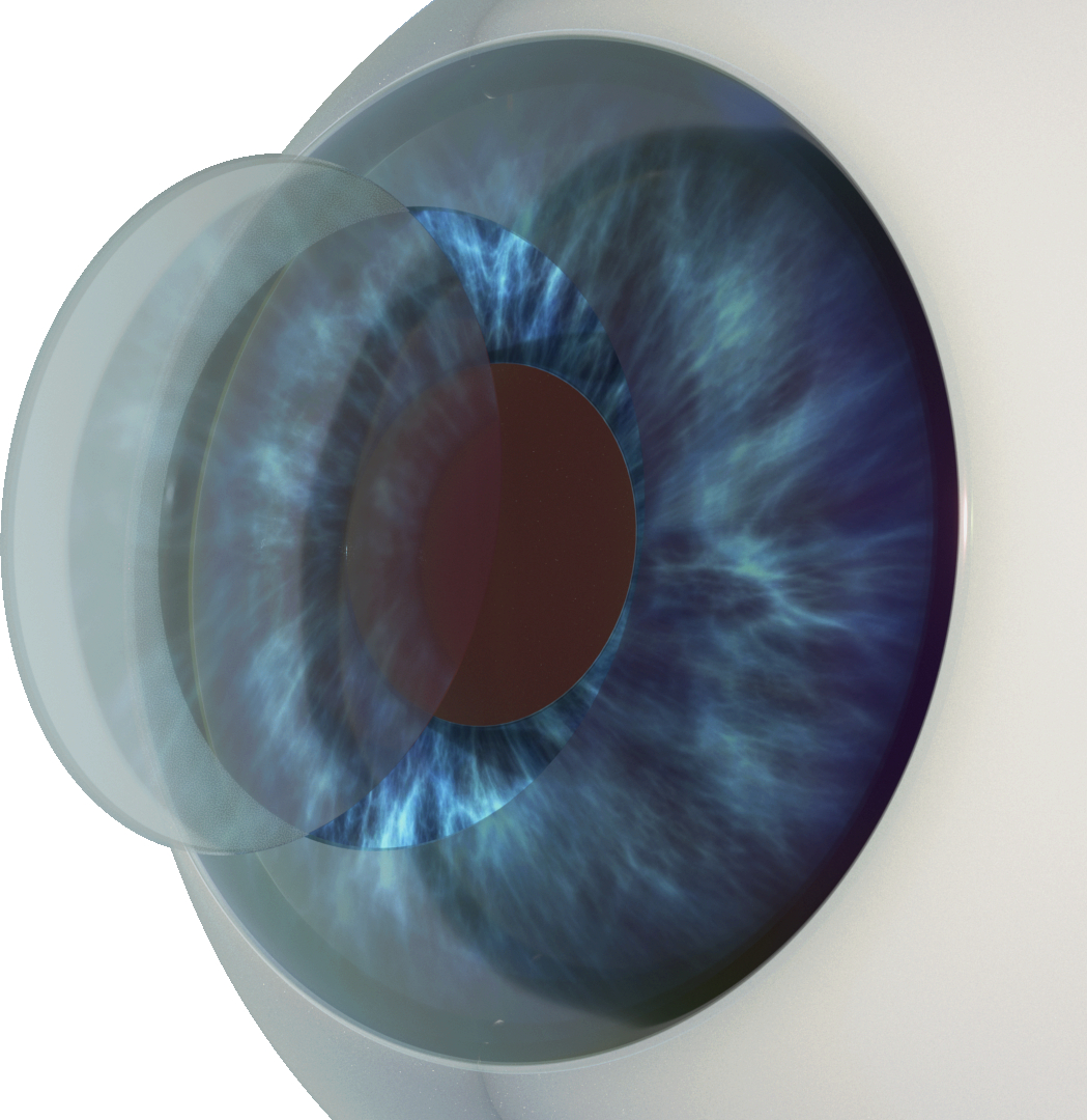 Refractive Eye Surgery in Vaishali Nagar, bilaspur – See the World Clearly with ASG Eye Hospital