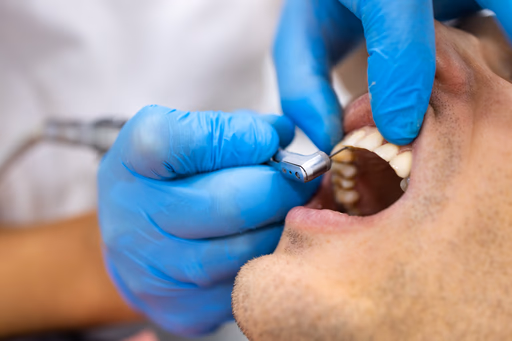 Tooth Extraction